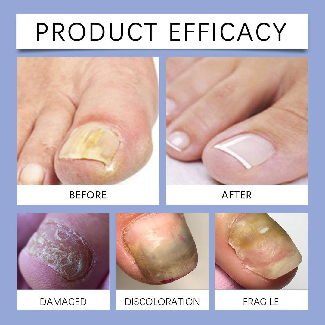Nail care Nail Treat ment for Toenail - Anti Nail for Thickening Yellow -
