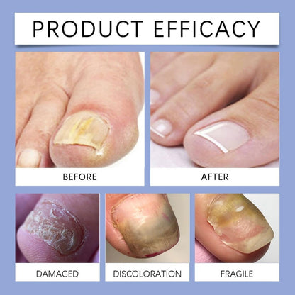 Nail care Nail Treat ment for Toenail - Anti Nail for Thickening Yellow -